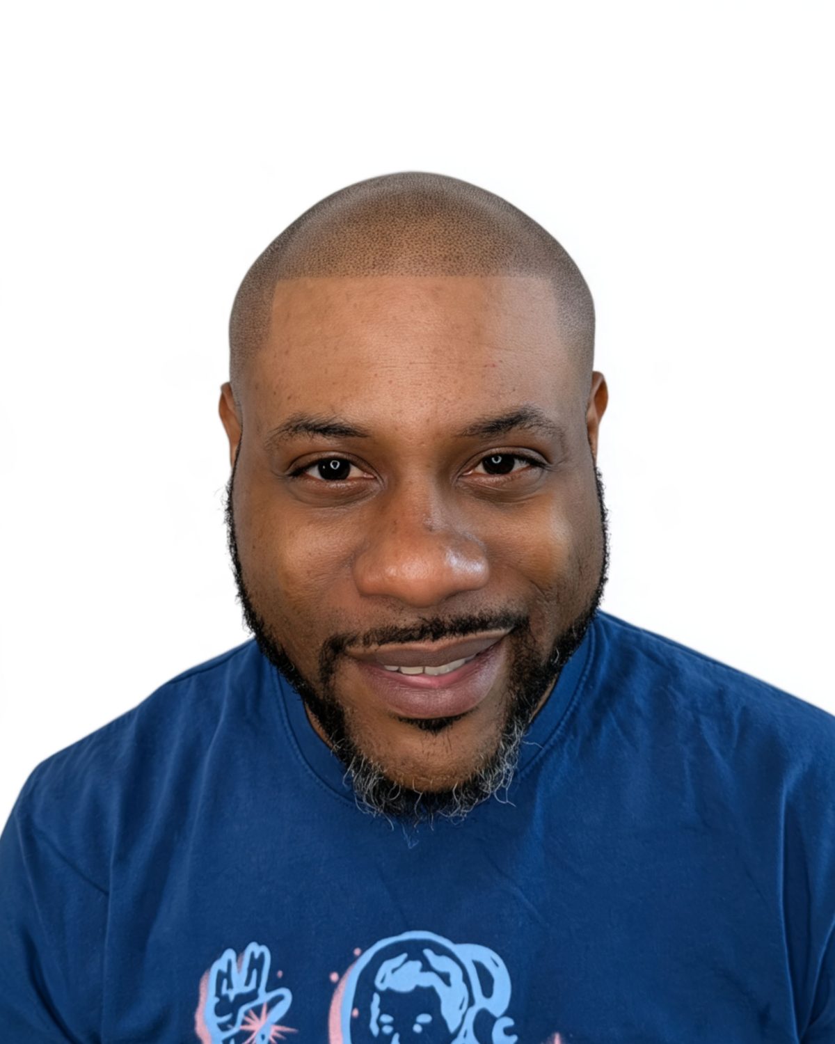 Full scalp, soft hairline: after treatment