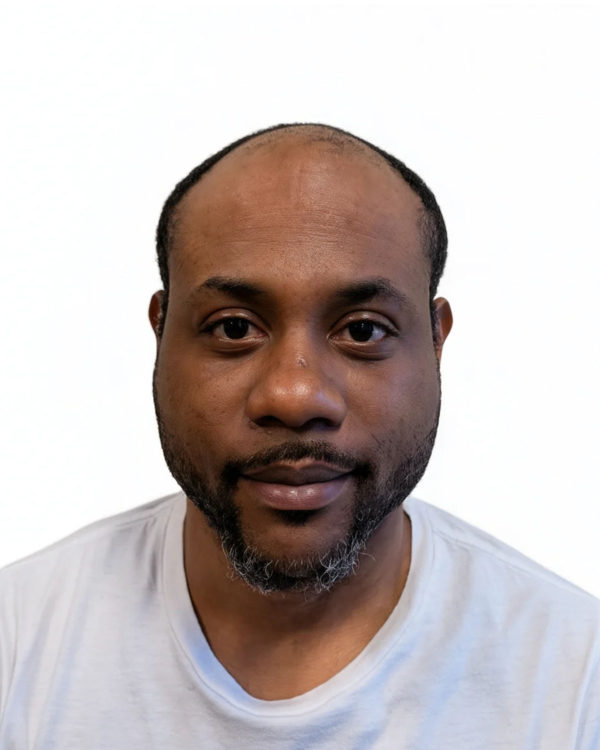 Full scalp, soft hairline: before treatment