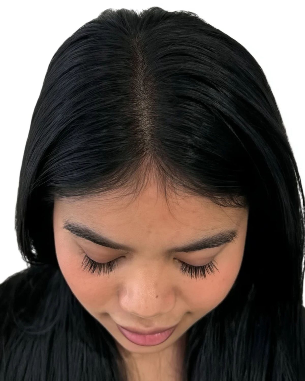Case 05, thinning along the part line: after treatment