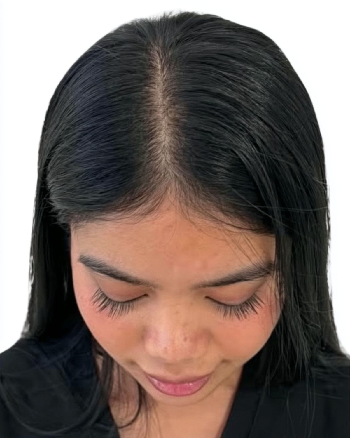 Case 05, thinning along the part line: before treatment