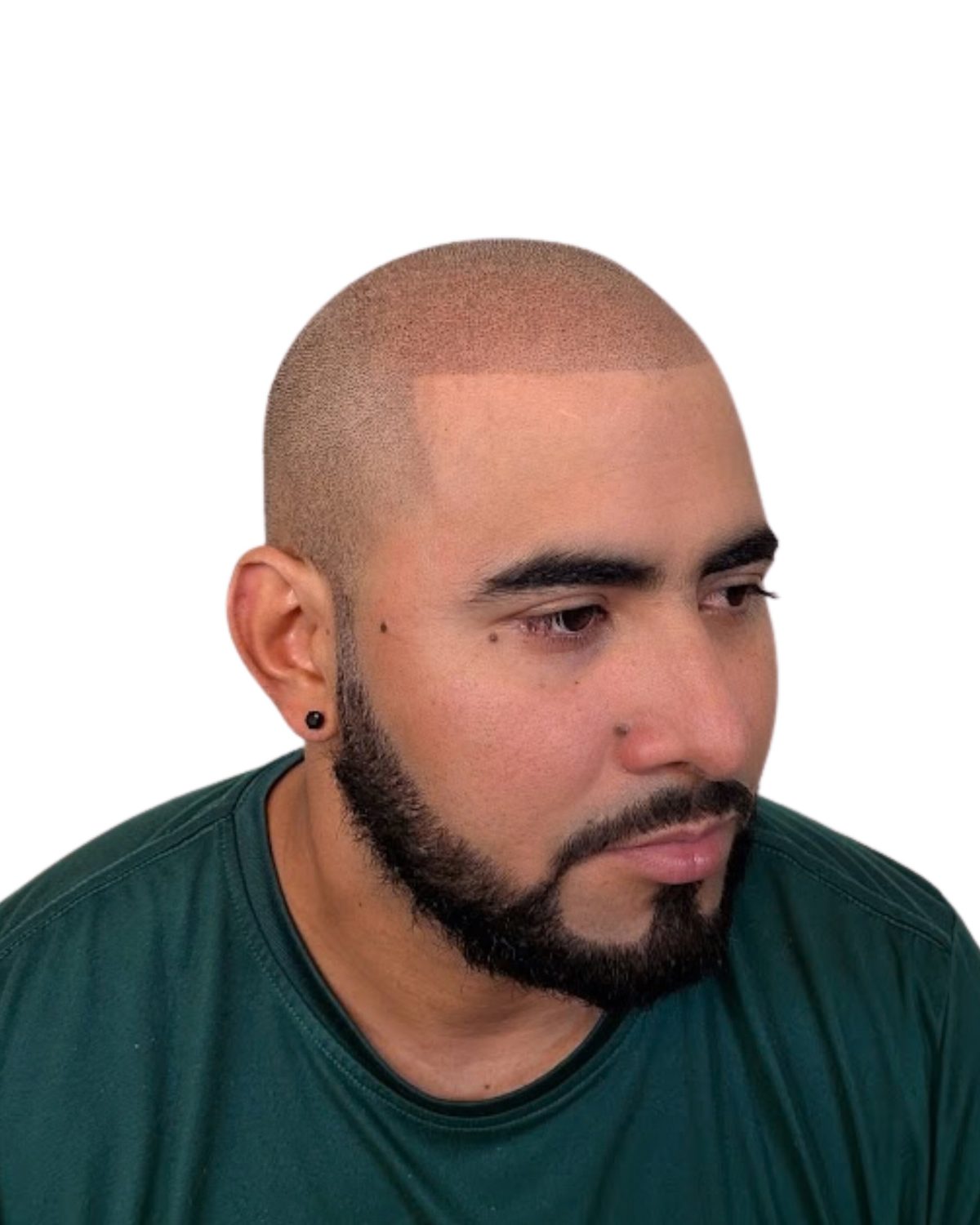 Full scalp, hard hairline: after treatment