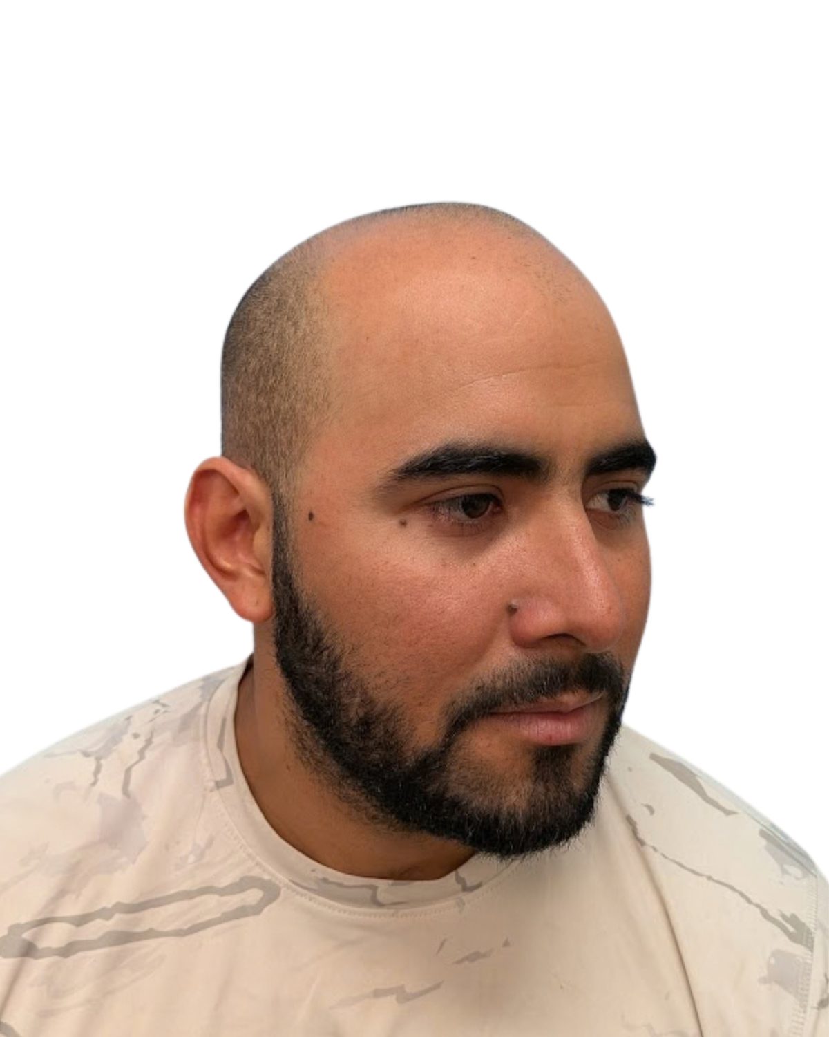 Full scalp, hard hairline: before treatment