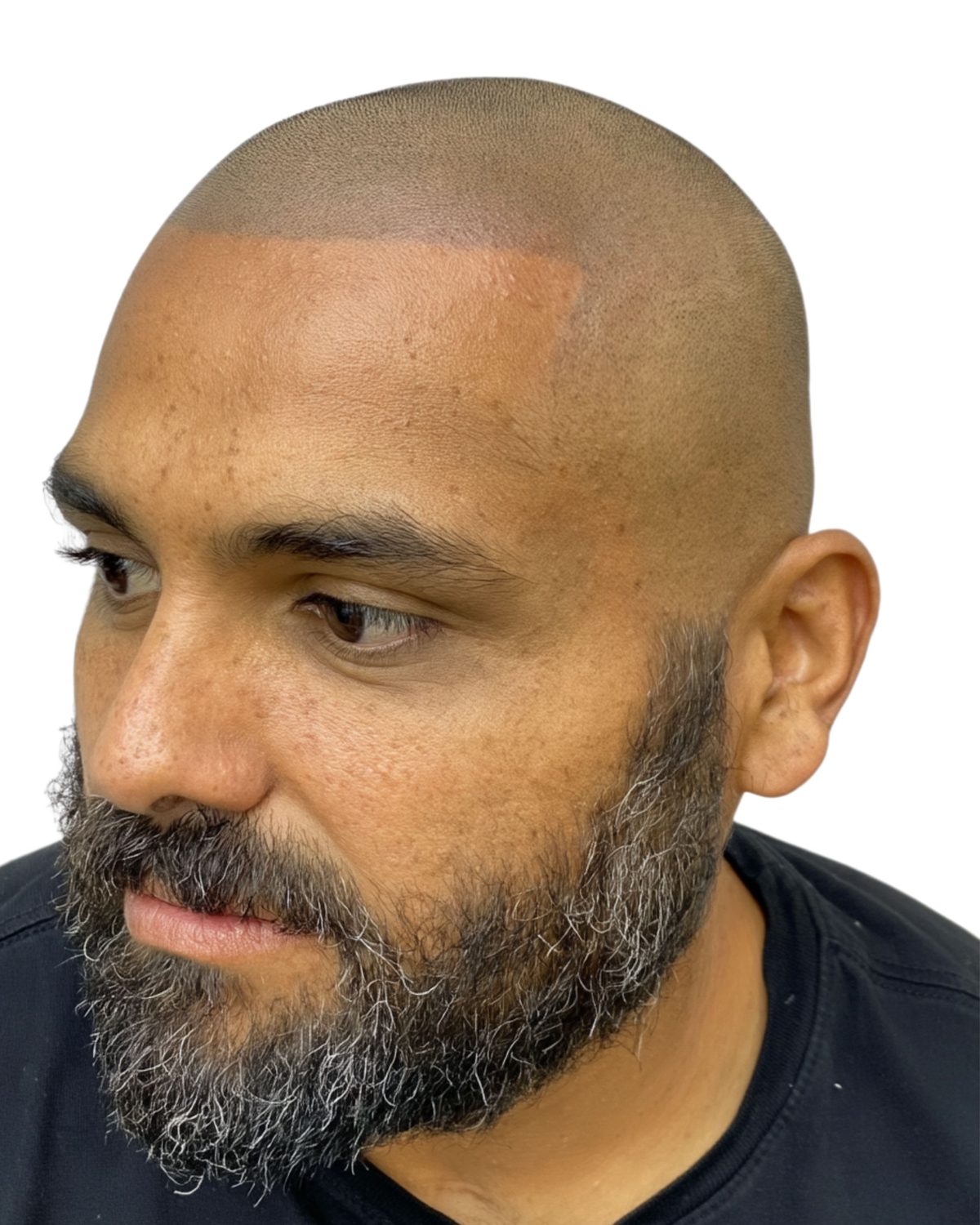 Hard hairline: after treatment