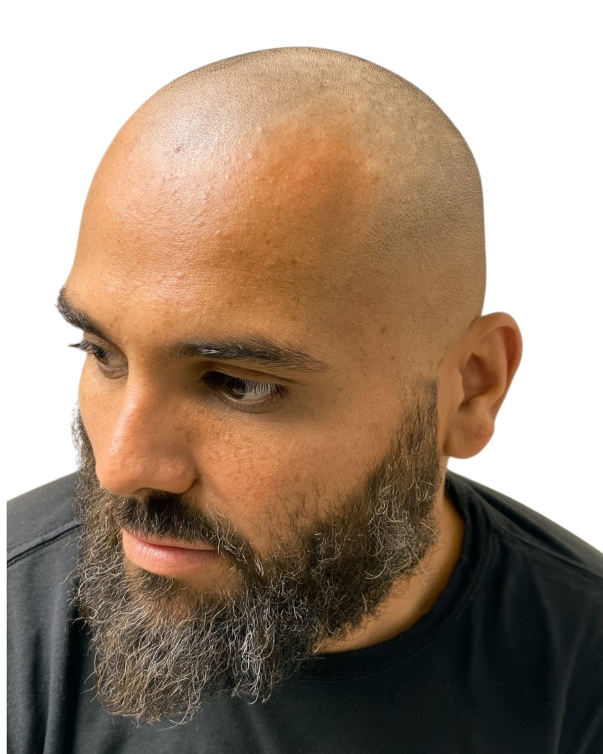 Hard hairline: before treatment